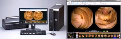 撮影された腸内部